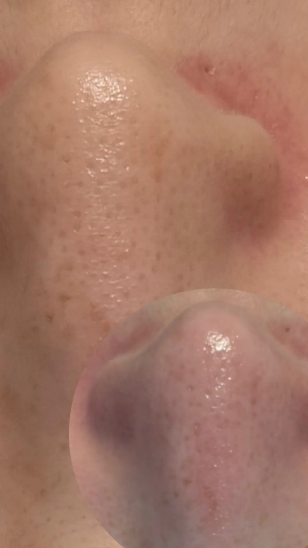 SNSで話題！韓国式3D毛穴洗浄 | ギャラリー | 京都府亀岡のエステなら