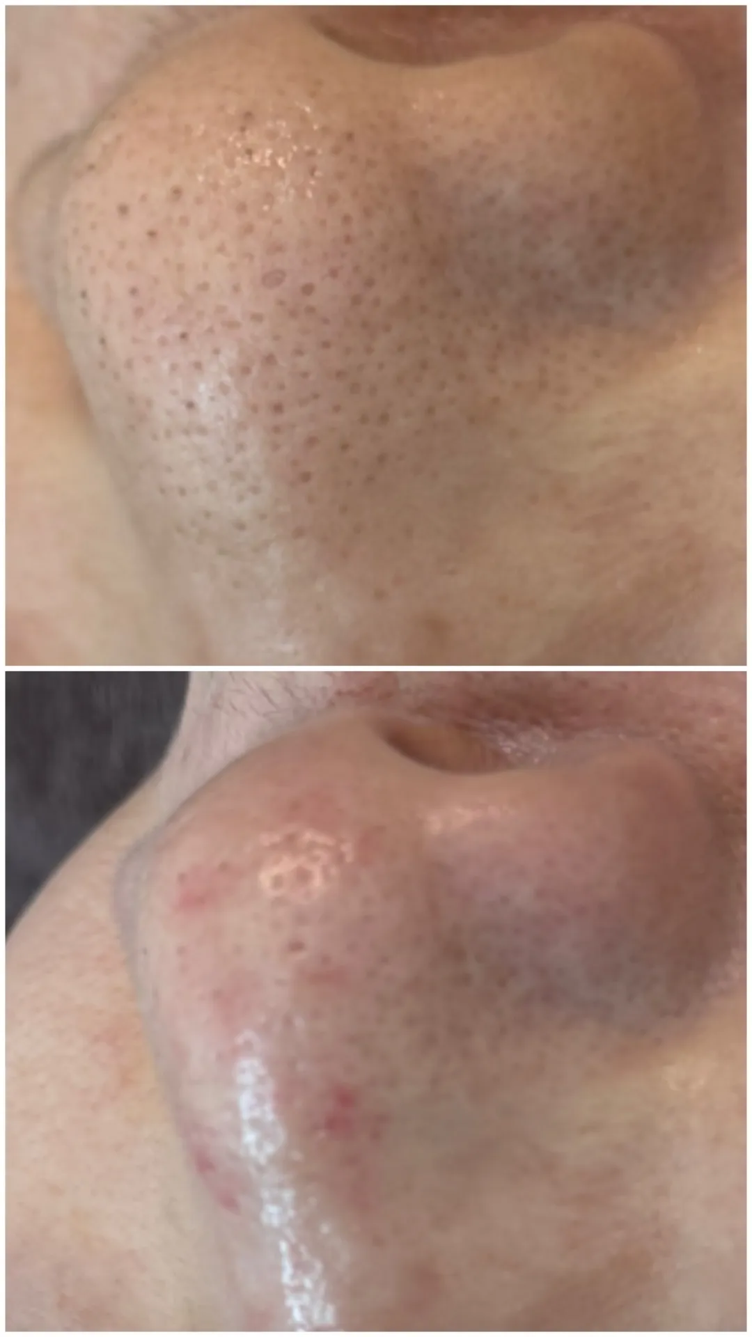 SNSで話題！韓国式3D毛穴洗浄