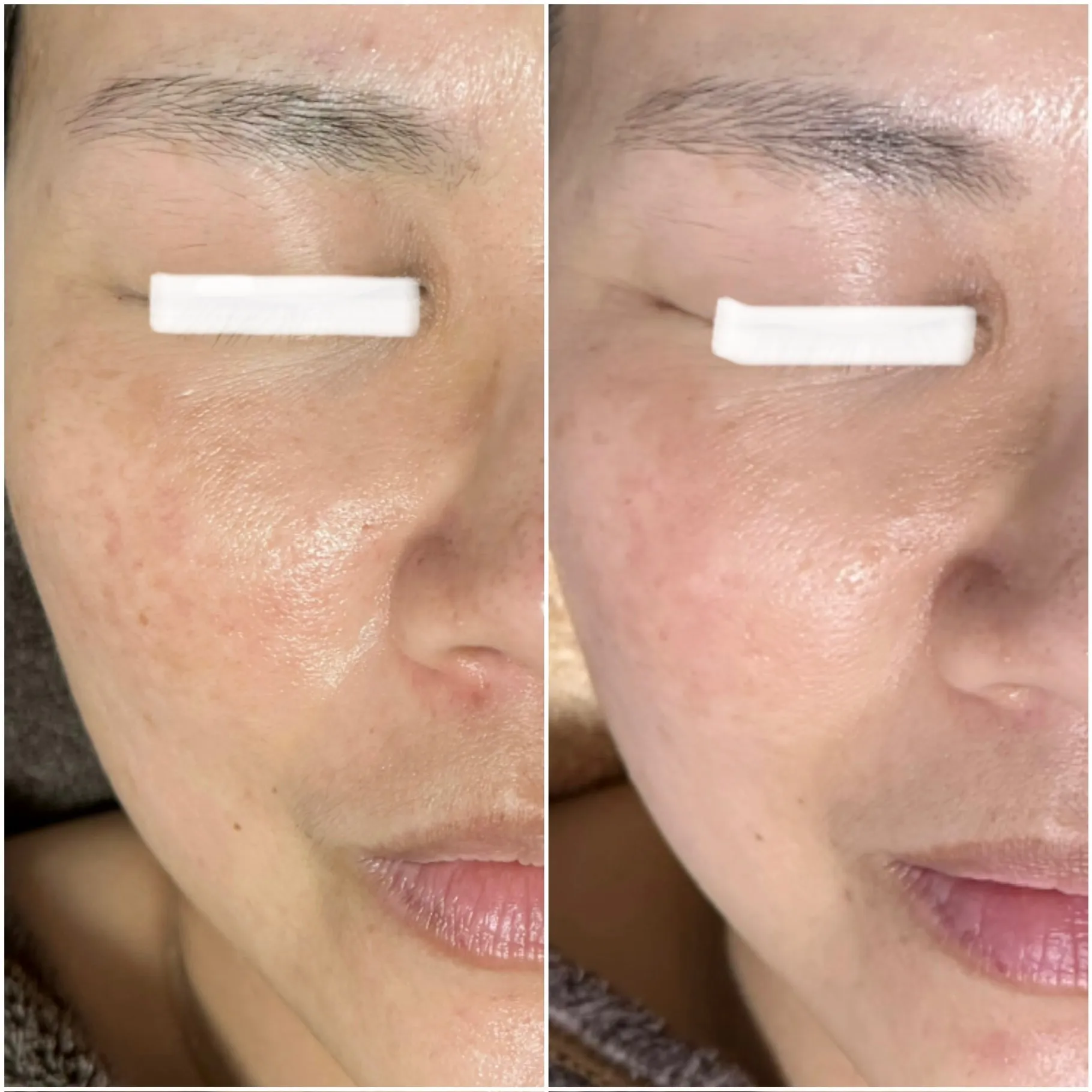 肌質改善｜Fuusalon｜ハーブピーリング🌿｜毛穴洗浄